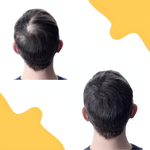 Non-Surgical Hair Replacement Therapy