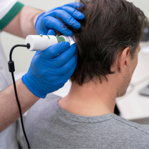Non-Surgical Hair Replacement